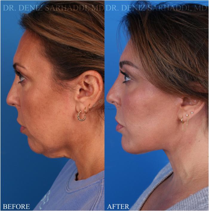 Before & After Facelift Case 347 Right Side View in St. Louis, MO