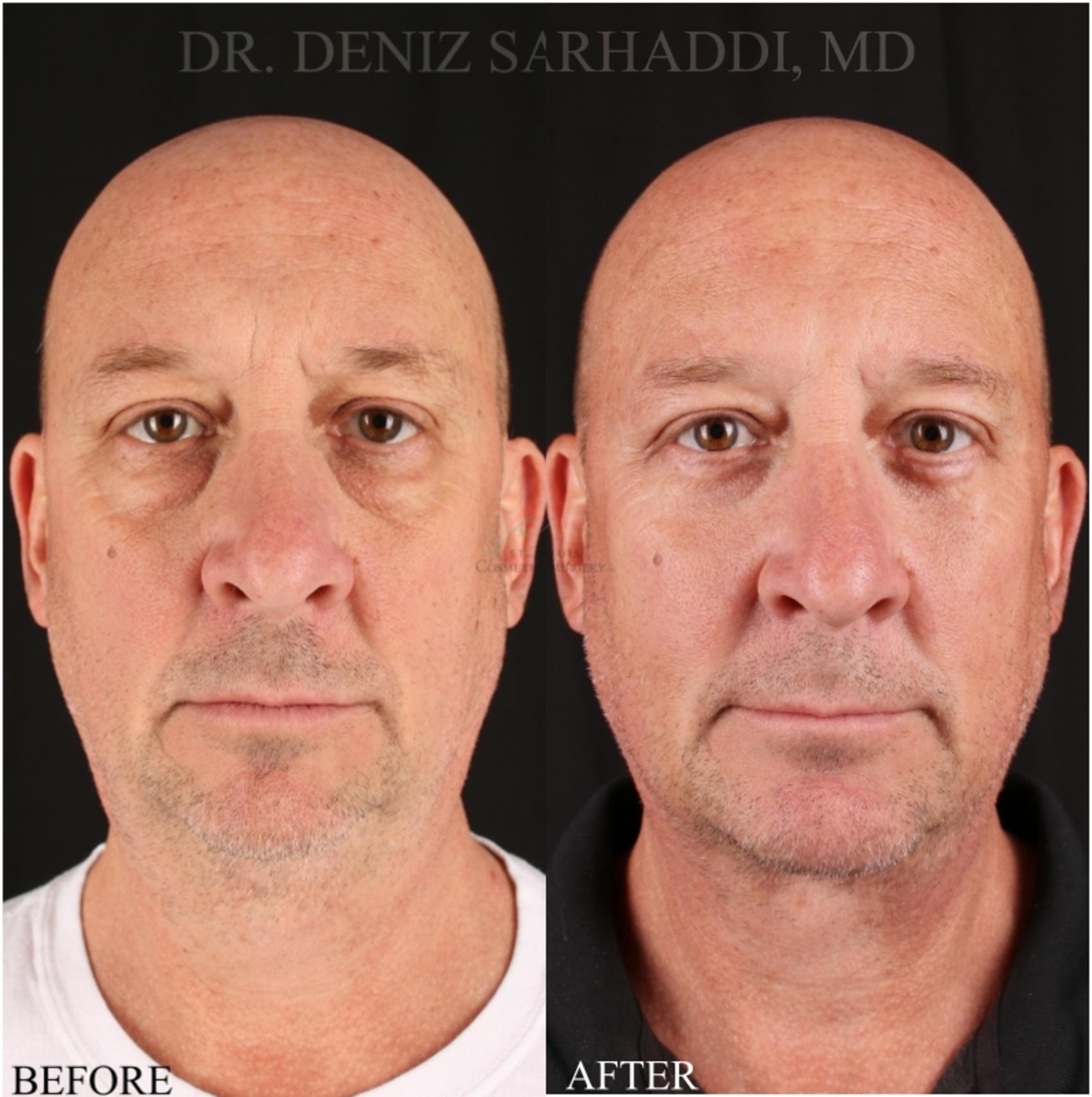 Before & After Neck Lift Case 348 Front View in St. Louis, MO