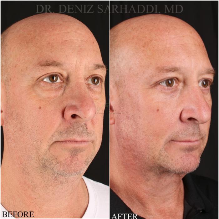 Before & After Facelift Case 348 Left Oblique View in St. Louis, MO