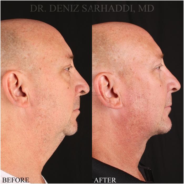 Before & After Eyelid Surgery Case 348 Left Side View in St. Louis, MO