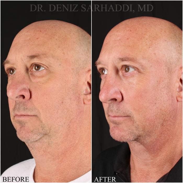 Before & After Neck Lift Case 348 Right Oblique View in St. Louis, MO