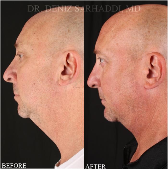 Before & After Neck Lift Case 348 Right Side View in St. Louis, MO