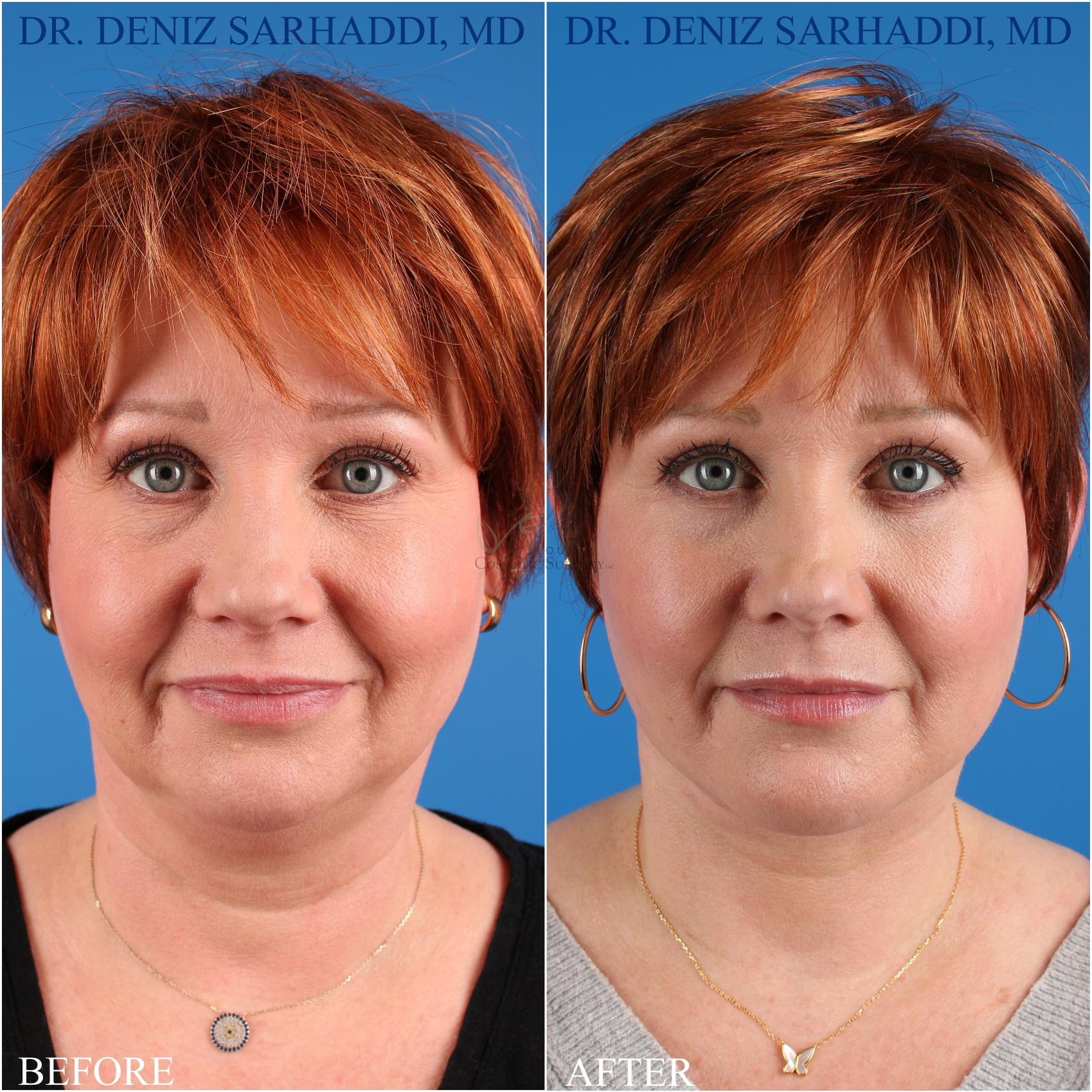 Before & After Neck Lift Case 349 Front View in St. Louis, MO