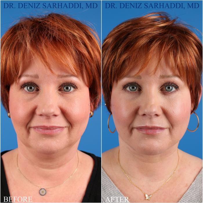 Before & After Facelift Case 349 Front View in St. Louis, MO