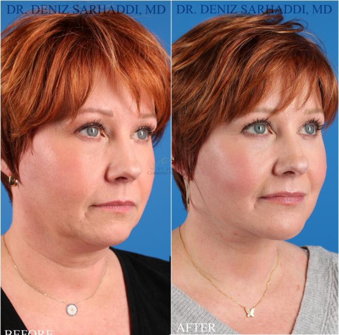 Before & After Facelift Case 349 Left Oblique View in St. Louis, MO