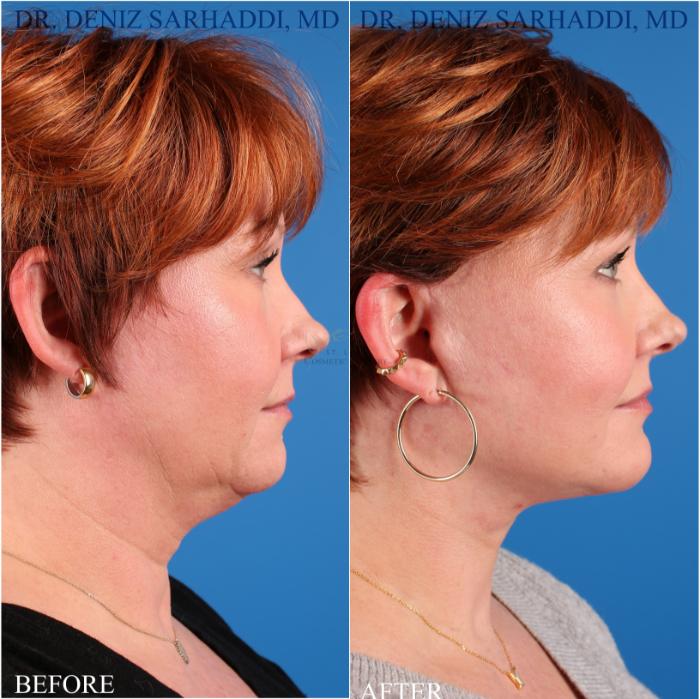 Before & After Facelift Case 349 Left Side View in St. Louis, MO