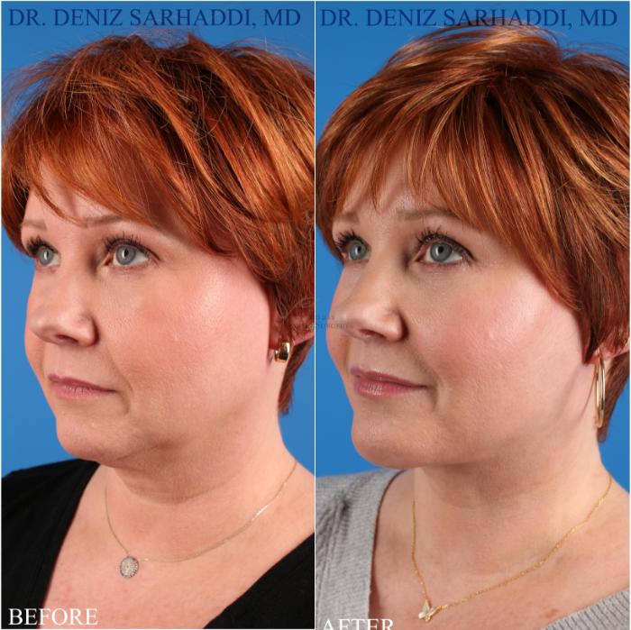 Before & After Neck Lift Case 349 Right Oblique View in St. Louis, MO