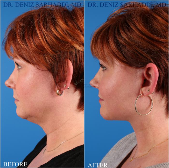 Before & After Neck Lift Case 349 Right Side View in St. Louis, MO