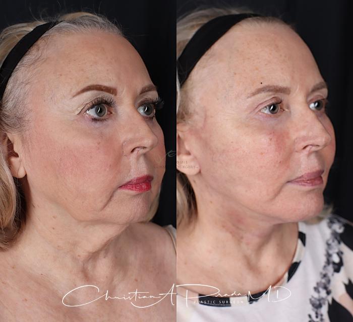 Before & After Chin Enhancement Case 411 Left Oblique View in St. Louis, MO