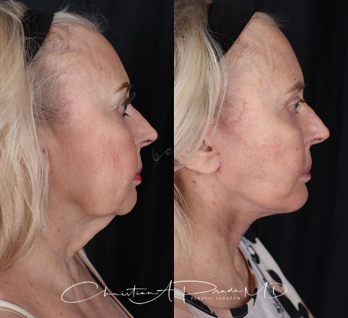 Before & After Chin Enhancement Case 411 Left Side View in St. Louis, MO