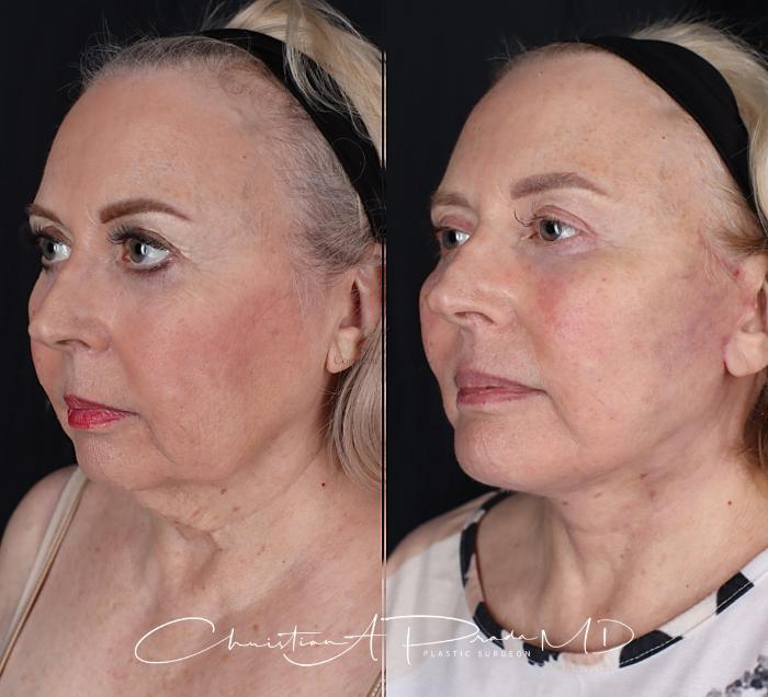 Before & After Chin Enhancement Case 411 Right Oblique View in St. Louis, MO