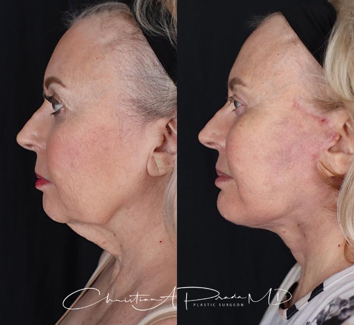 Before & After Chin Enhancement Case 411 Right Side View in St. Louis, MO