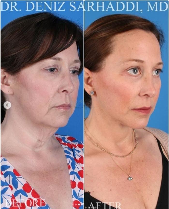 Before & After Neck Lift Case 417 Left Oblique View in St. Louis, MO