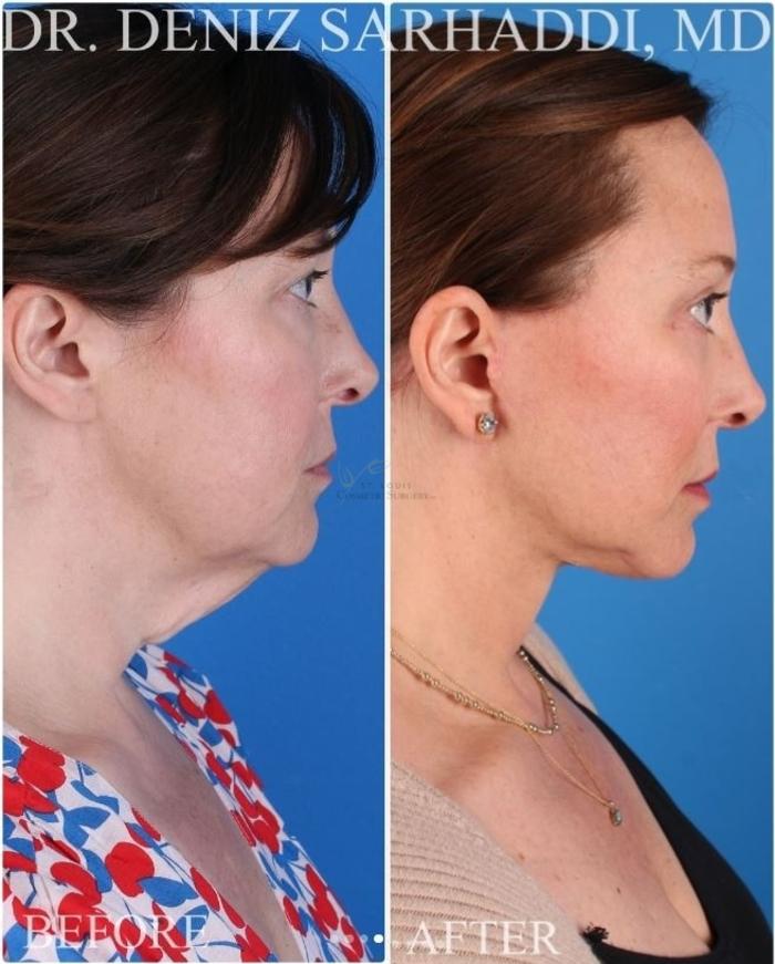 Before & After Neck Lift Case 417 Left Side View in St. Louis, MO