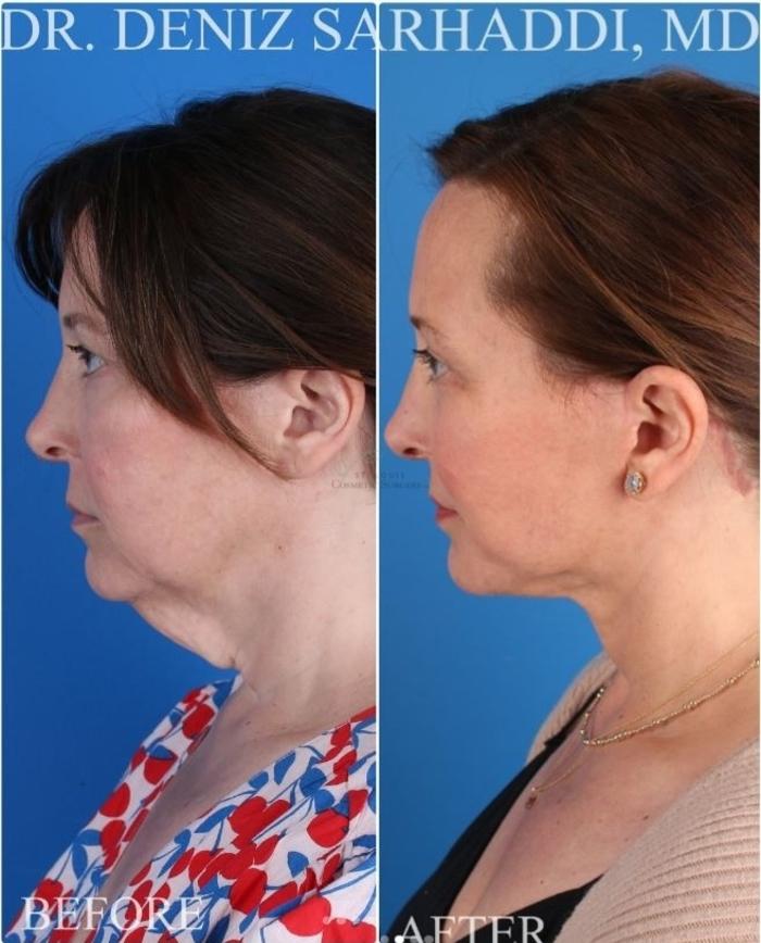 Before & After Neck Lift Case 417 Right Side View in St. Louis, MO