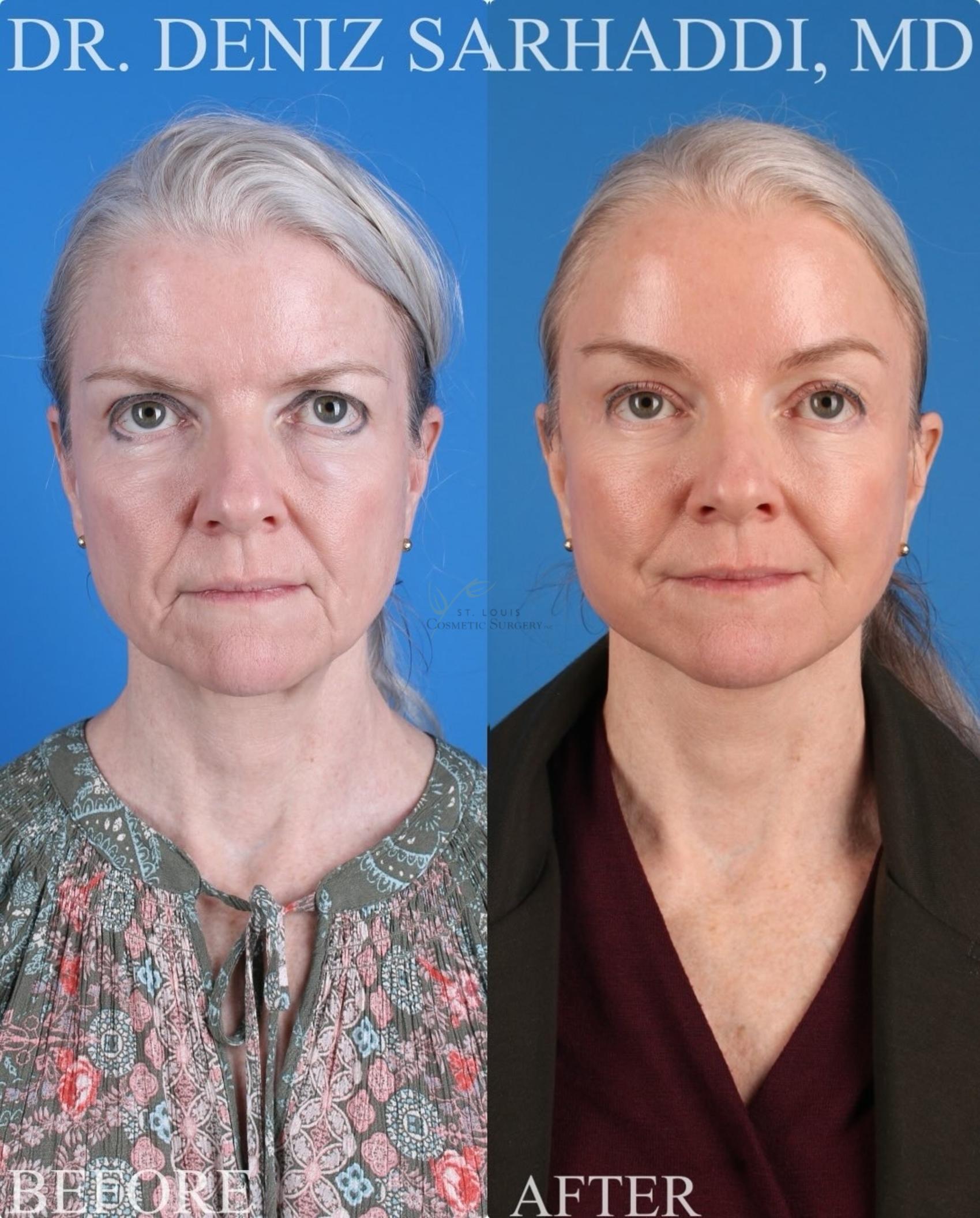 Before & After Facelift Case 429 Front View in St. Louis, MO