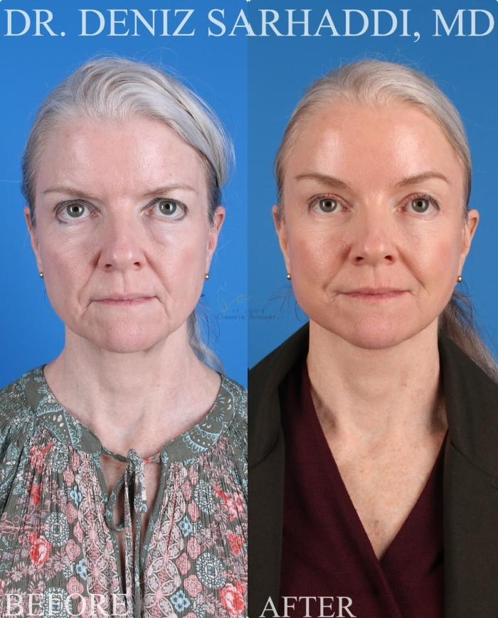 Before & After Facelift Case 429 Front View in St. Louis, MO