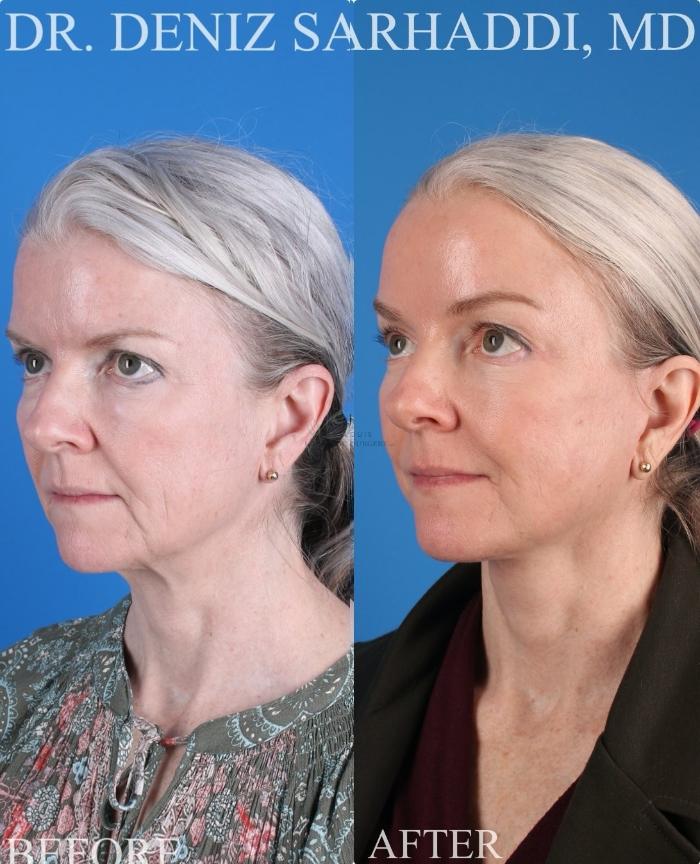 Before & After Facelift Case 429 Left Oblique View in St. Louis, MO
