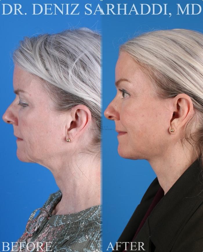 Before & After Facelift Case 429 Left Side View in St. Louis, MO