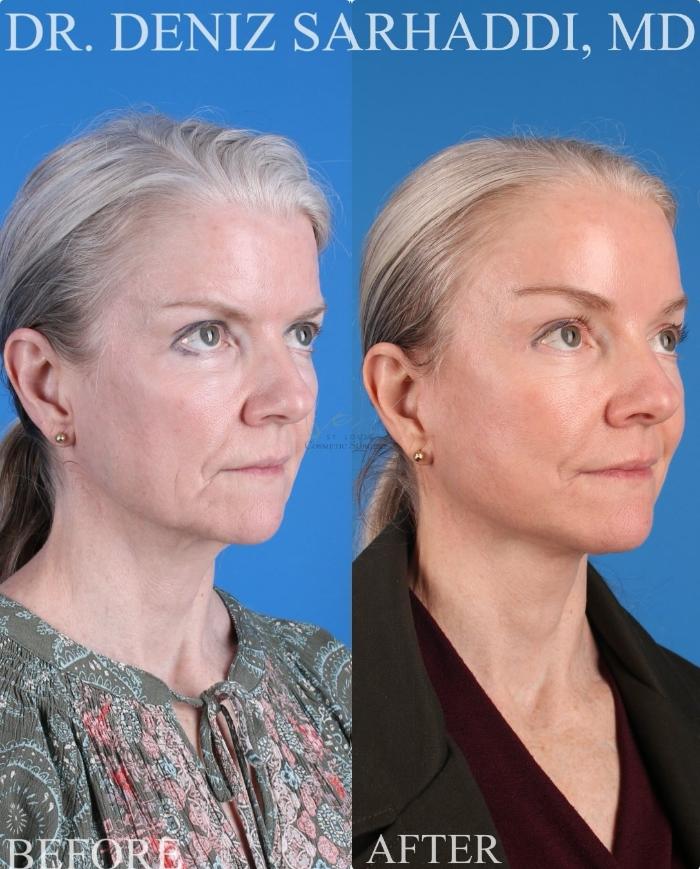 Before & After Facelift Case 429 Right Oblique View in St. Louis, MO