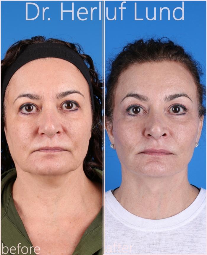 Before & After Facelift Case 432 Front View in St. Louis, MO