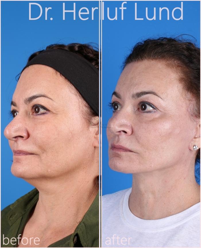Before & After Facelift Case 432 Left Oblique View in St. Louis, MO