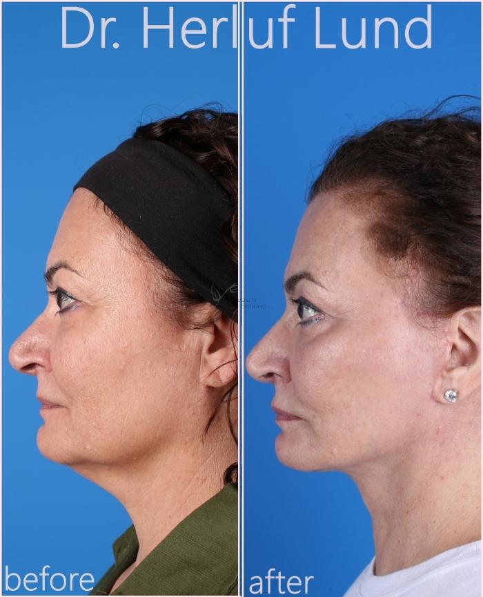 Before & After Facelift Case 432 Left Side View in St. Louis, MO