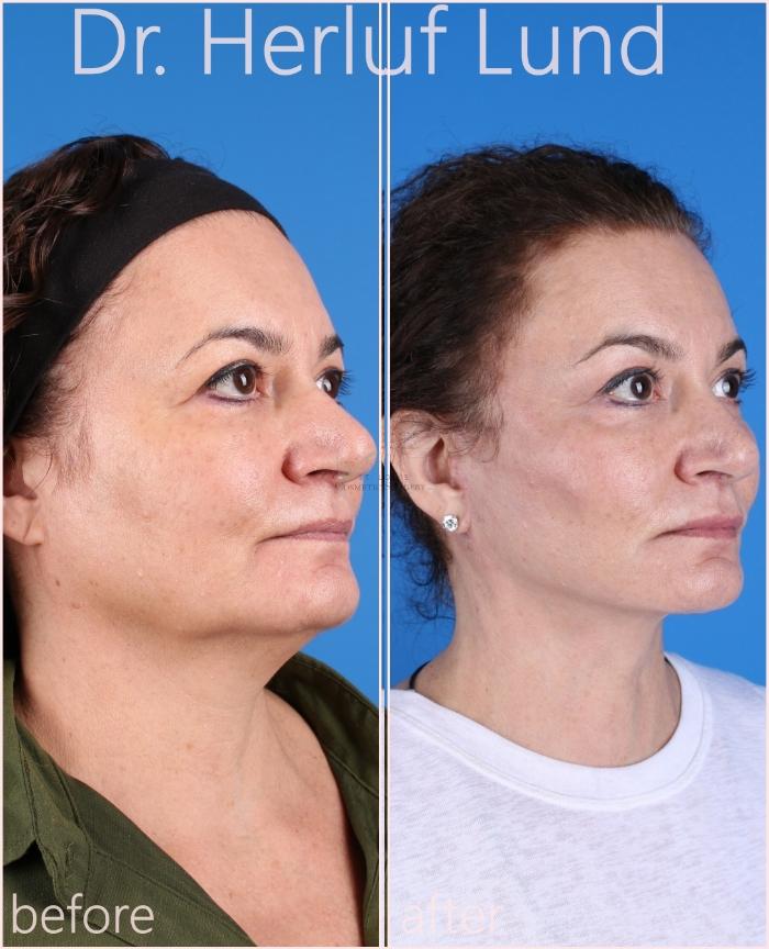 Before & After Facelift Case 432 Right Oblique View in St. Louis, MO