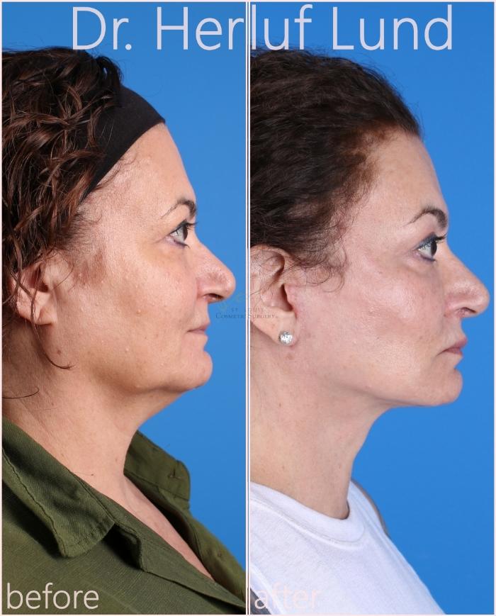 Before & After Facelift Case 432 Right Side View in St. Louis, MO