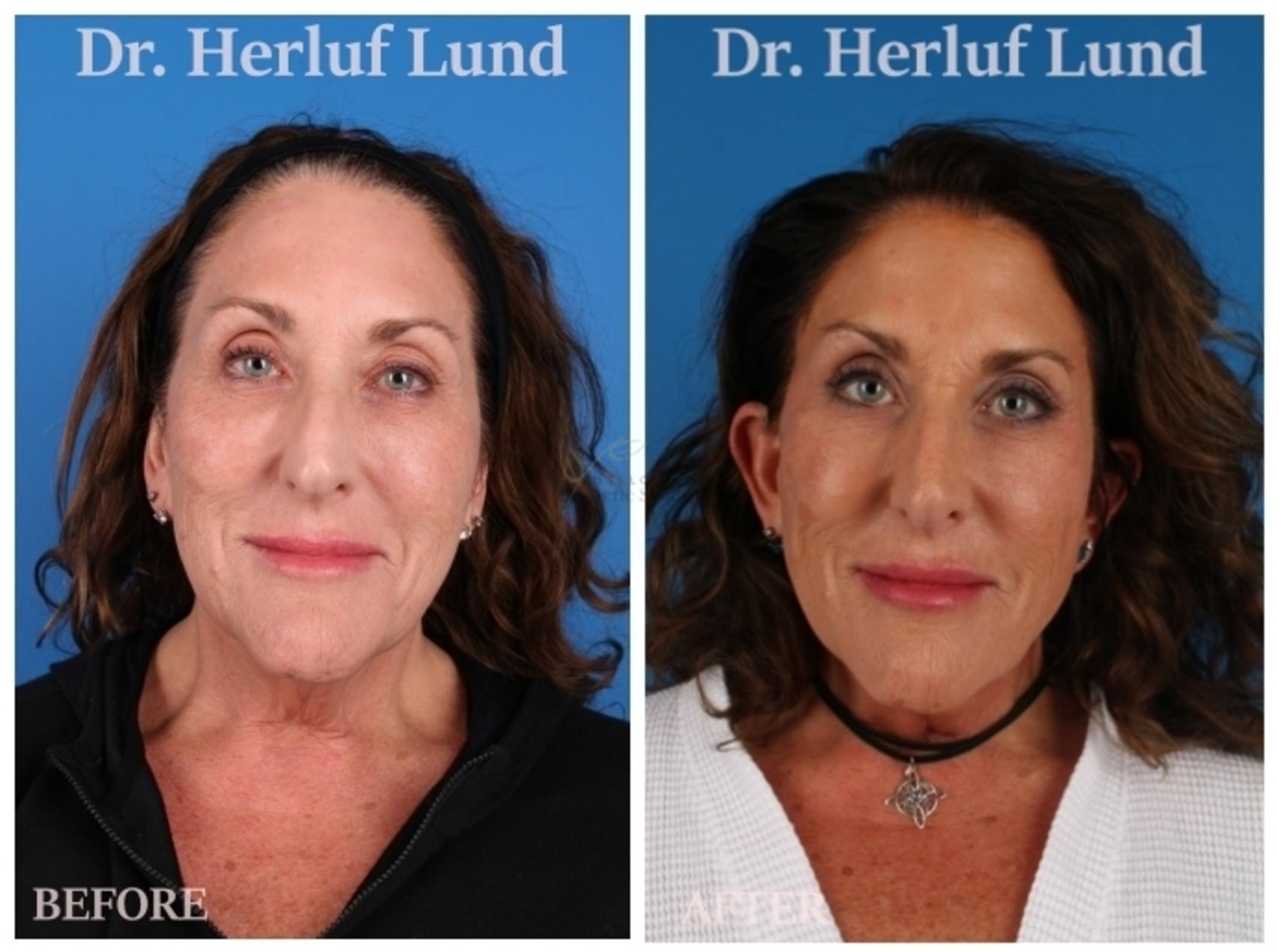 Before & After Facelift Case 437 Front View in St. Louis, MO