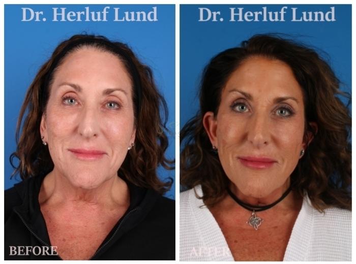 Before & After Facelift Case 437 Front View in St. Louis, MO