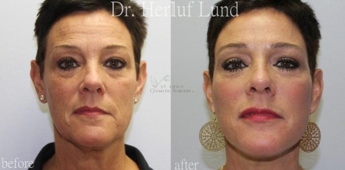 Before & After Facelift Case 439 Front View in St. Louis, MO