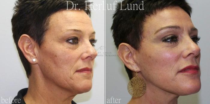 Before & After Facelift Case 439 Left Oblique View in St. Louis, MO