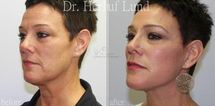 Before & After Facelift Case 439 Right Oblique View in St. Louis, MO