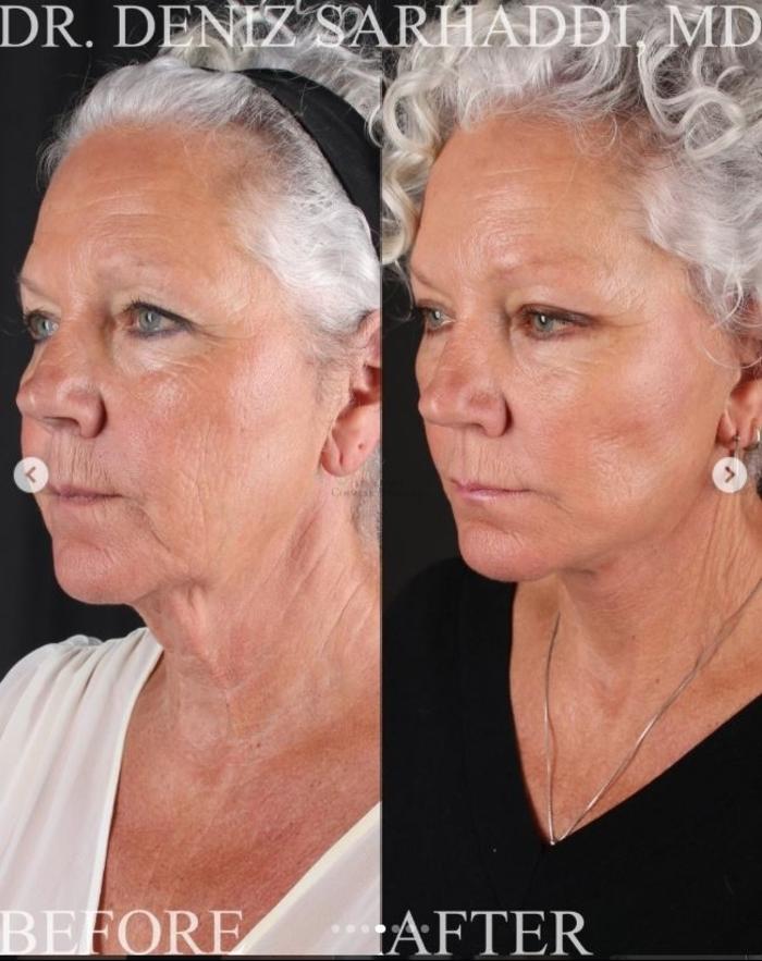 Before & After Facelift Case 467 Left Oblique View in St. Louis, MO