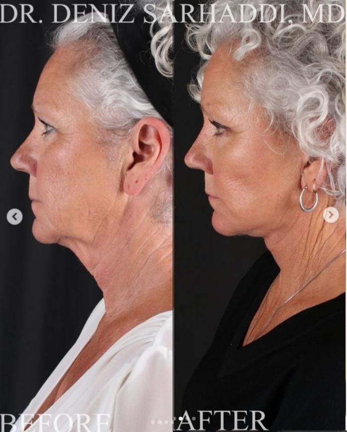 Before & After Facelift Case 467 Left Side View in St. Louis, MO