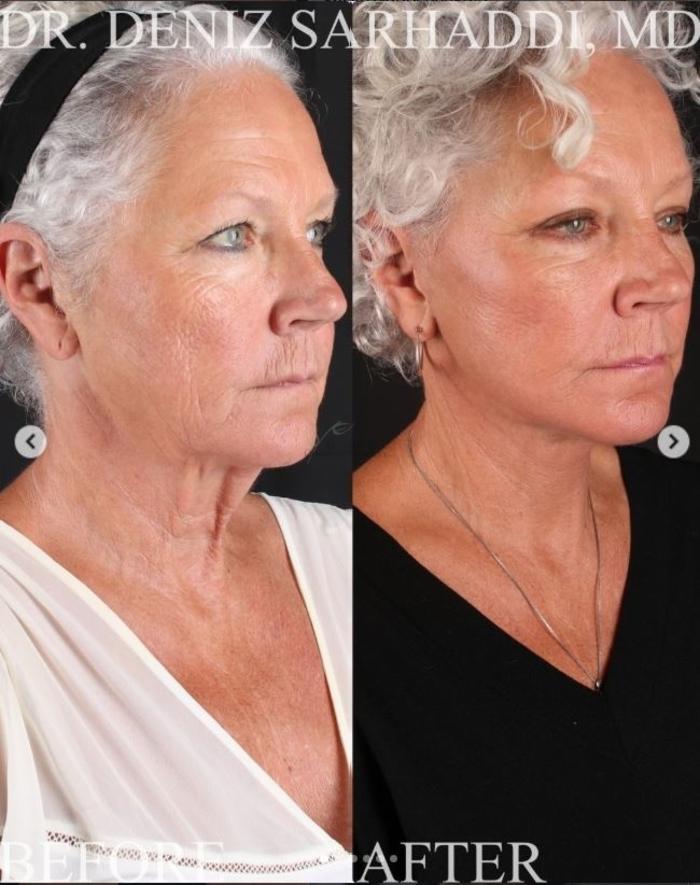 Before & After Facelift Case 467 Right Oblique View in St. Louis, MO