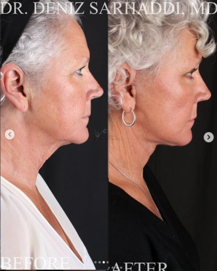 Before & After Facelift Case 467 Right Side View in St. Louis, MO