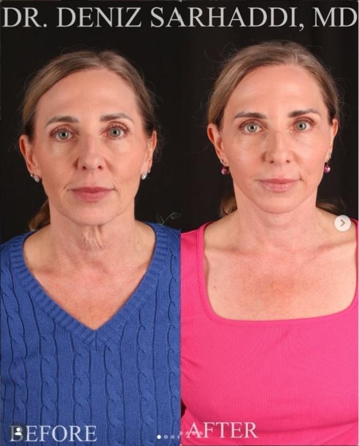 Before & After Facelift Case 468 Front View in St. Louis, MO