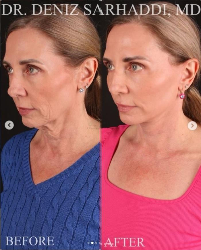 Before & After Facelift Case 468 Left Oblique View in St. Louis, MO