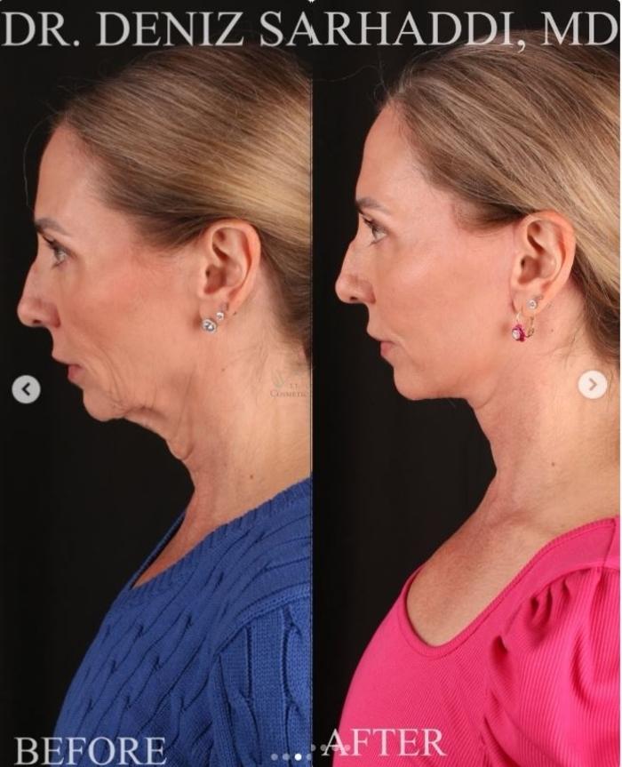 Before & After Facelift Case 468 Left Side View in St. Louis, MO