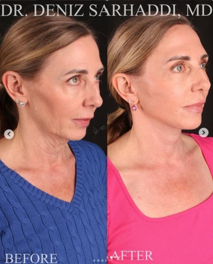 Before & After Facelift Case 468 Right Oblique View in St. Louis, MO