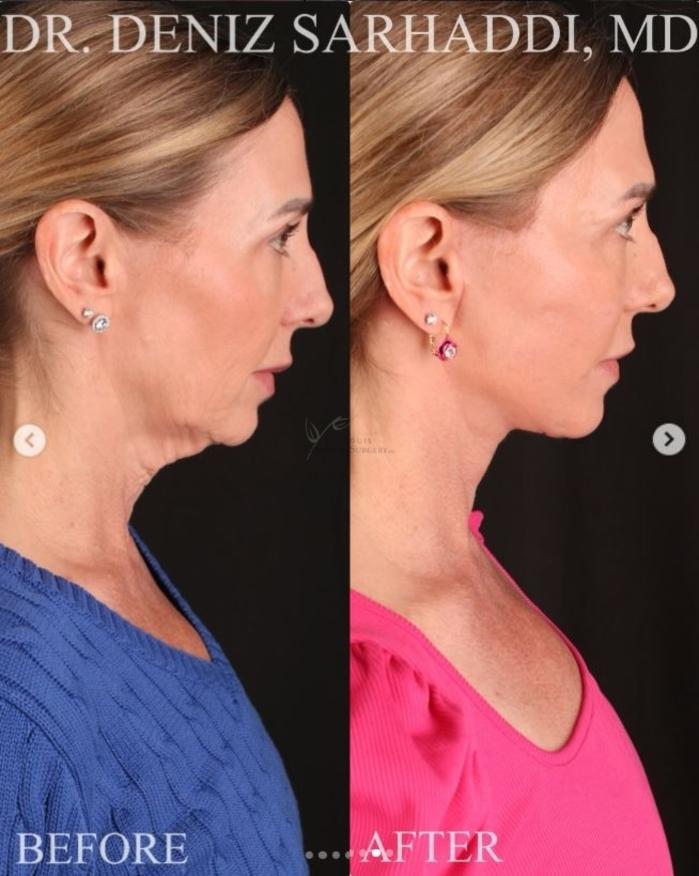 Before & After Facelift Case 468 Right Side View in St. Louis, MO