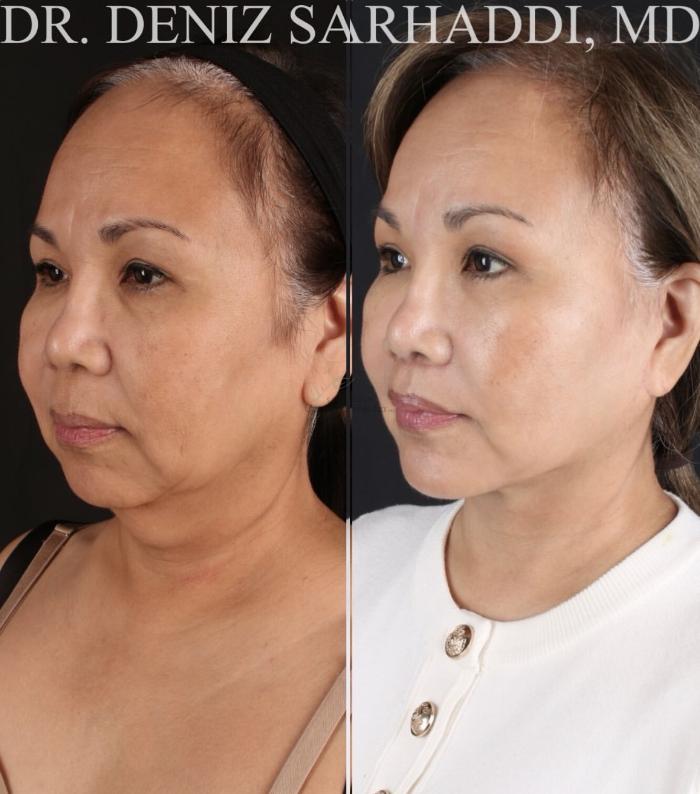 Before & After Facelift Case 471 Left Oblique View in St. Louis, MO