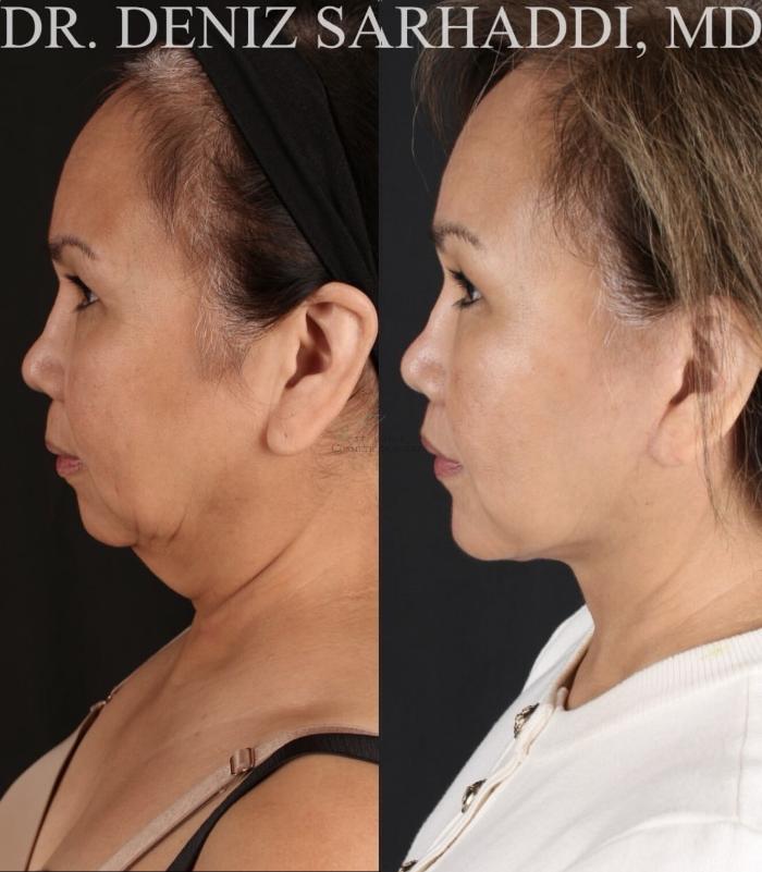 Before & After Facelift Case 471 Left Side View in St. Louis, MO