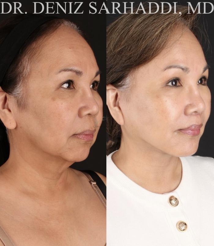 Before & After Facelift Case 471 Right Oblique View in St. Louis, MO