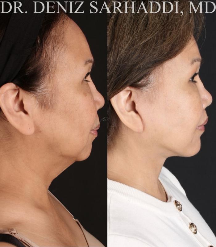 Before & After Facelift Case 471 Right Side View in St. Louis, MO