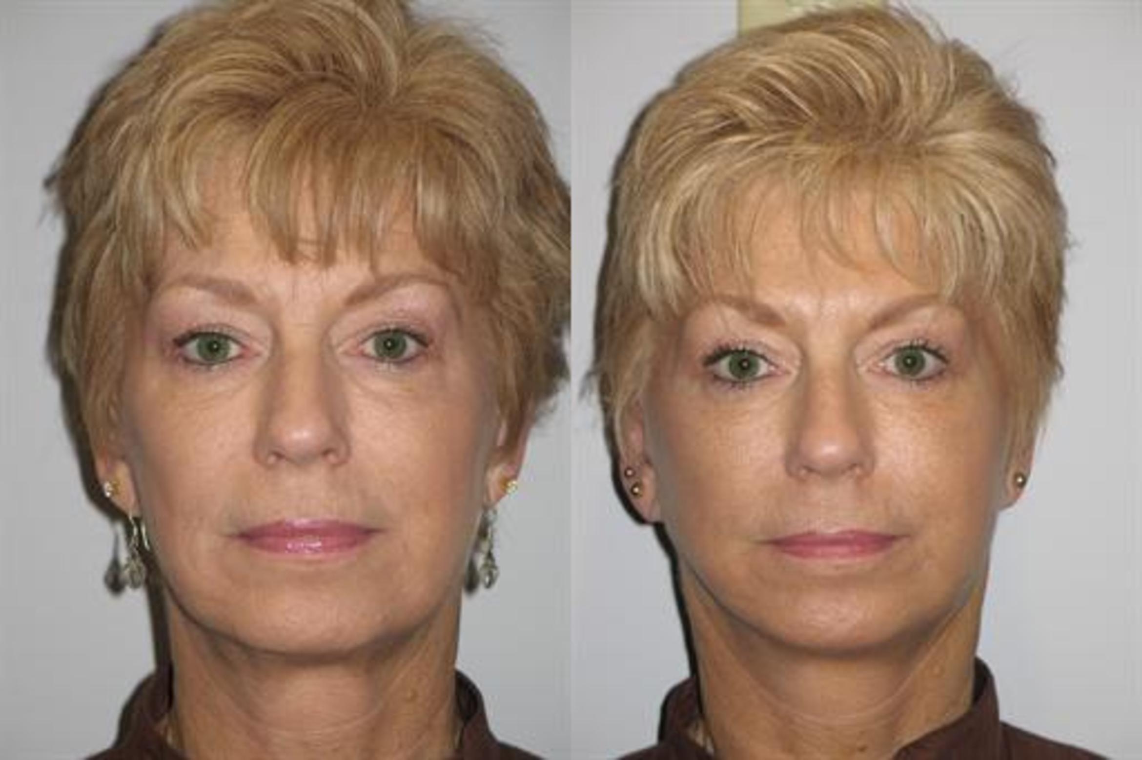Plastic Surgery in Chesterfield, MO | St. Louis Plastic Surgery