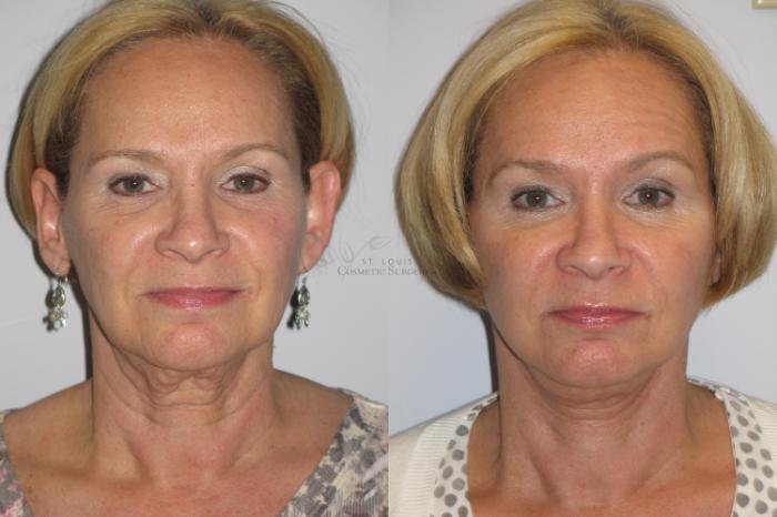 Before & After Facelift Case 76 View #1 View in St. Louis, MO