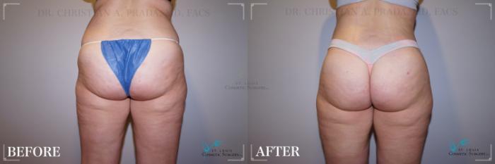 Before & After Liposuction Case 225 Back View in St. Louis, MO